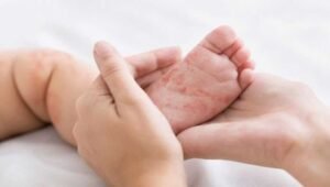 Ilustrasi Campak. (Foto: Shitterstock).