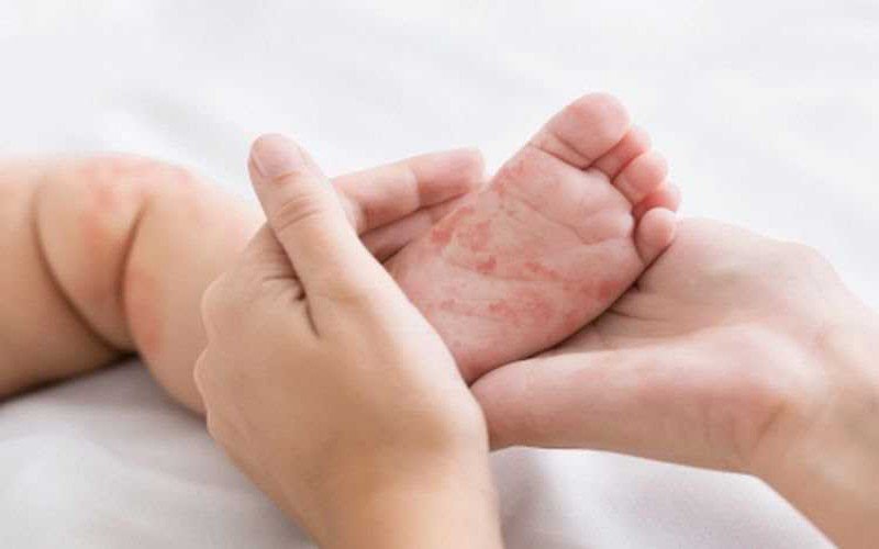 Ilustrasi Campak. (Foto: Shitterstock).